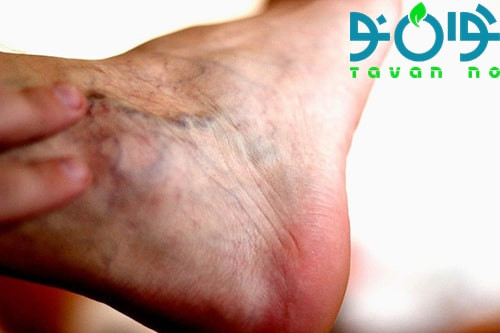 هرآنچه از جوراب واریس میدانید-03